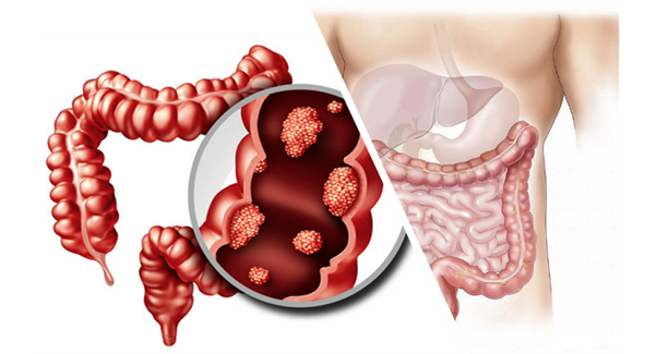 colon cancer picture