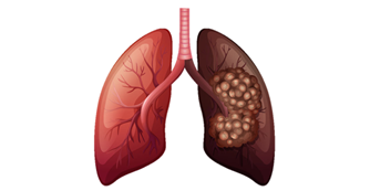 Damaged lungs